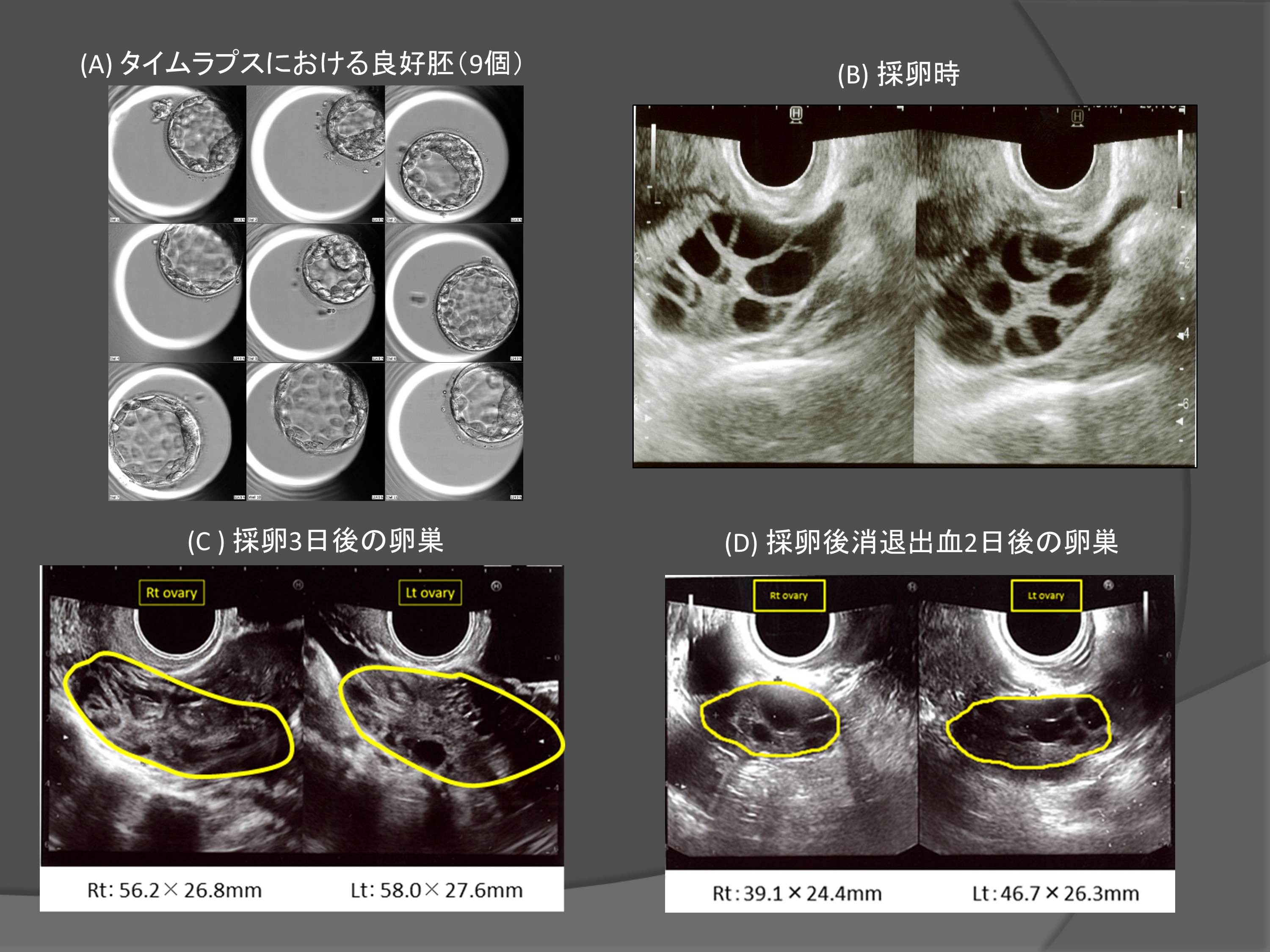 多嚢胞性卵巣症候群 Pcos に対する新しい排卵誘発法 セントマザー産婦人科医院